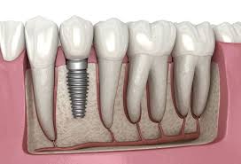 Azərbaycanda diş müalicəsi və implant qiymətləri – klinikalar üzrə müqayisə